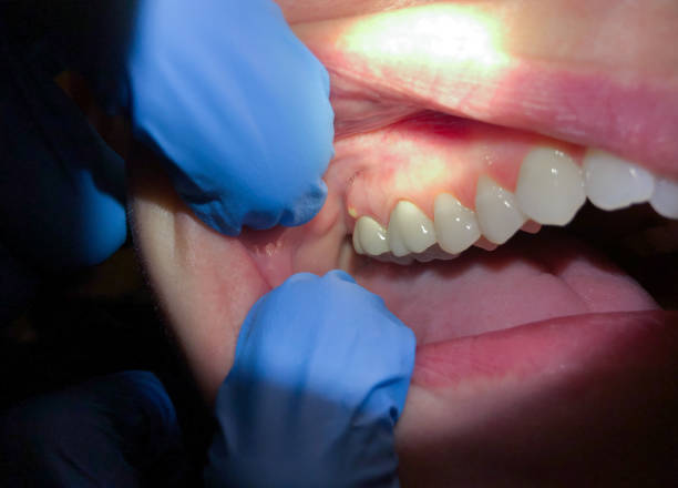 Best Emergency Care for Gum Disease in Brownfields, LA
