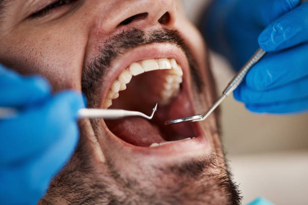 Best Knocked-Out Tooth (Avulsed Tooth) Treatment in Brownfields, LA
